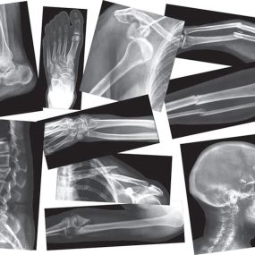 Broken Bones X Rays