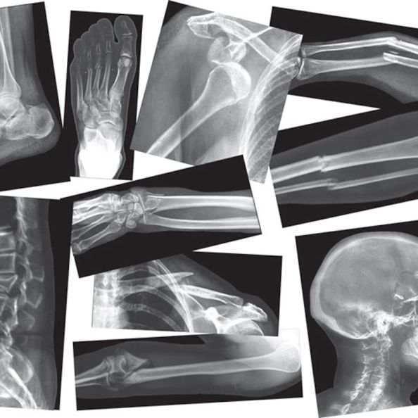 Broken Bones X Rays | Creative Activity